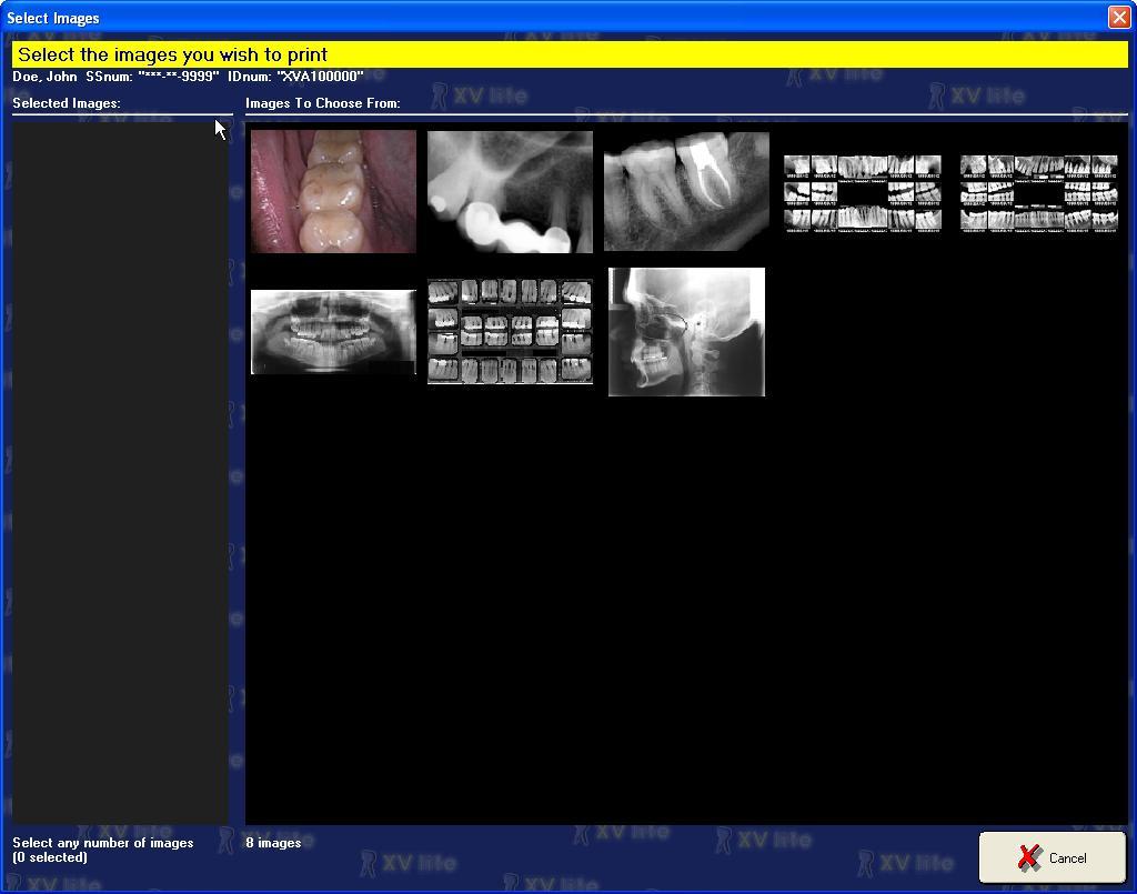 9.3.2 The Wizard will advance t an image selectin screen. 9.3.2.1 The Images T Chse Frm sectin n the right displays the current images in the patient s recrd.