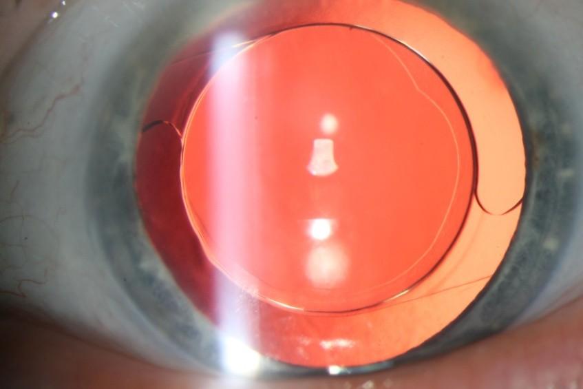16 of 21 Image 1: The SeeLens IOL as seen through a slit lamp, 3 months post operatively Image 1 shows that the SeeLens is well centered.