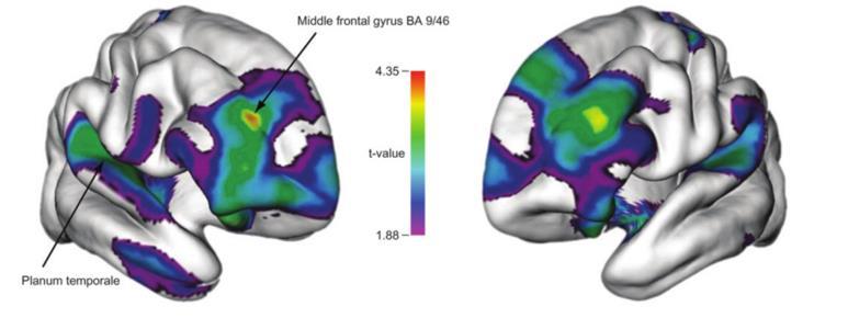 Brain Plasticity CORTICAL THICKNESS: musicians > non-musicians Frontal Lobes Motor