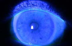 zone of scleral lenses