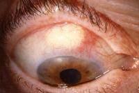 scleral issues such as pinguecula or blebs