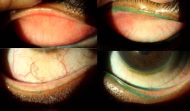 1. Treat ocular surface issues Lid hygiene Omega 3s Medication 2.