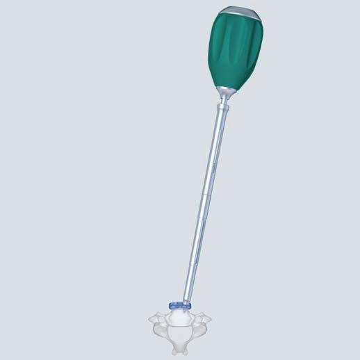 Option A Variable angle, self-drilling screw A 4 Break cortex Required instruments Awl 2.5 mm with trocar tip 324.