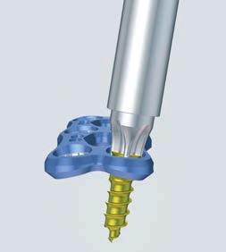 Implant removal 1 Clean screw head Required instruments Cleaning Instrument for Screw Head 324.