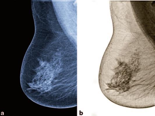 2. Intensity Transformations 47 Fig. 2.3 Digital mammogram: a original image, b negative intensity transformed image pixels are required.