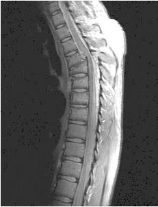 (a) (b) (c) (d) Figure 4.11 (a) Original MRI image of a human spine. (b)-(d) Results of applying power-law transformation with c = 1 and y =.6,.4, and.3, respectively.