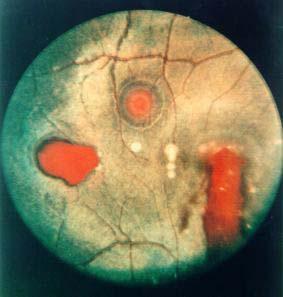 Absorption of radiation by the eye white spots: thermal burns => coagulation of retinal layers.