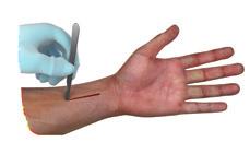 Incision A longitudinal incision is made in Henry s interval at the wrist (flexor carpi radialis