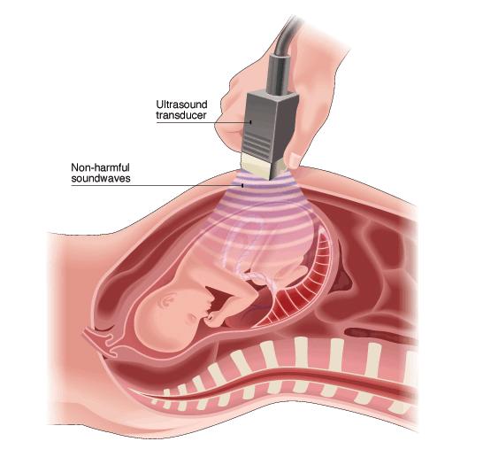Pregnancy Sonar of foetus.