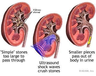 Treatment Kidney stones.
