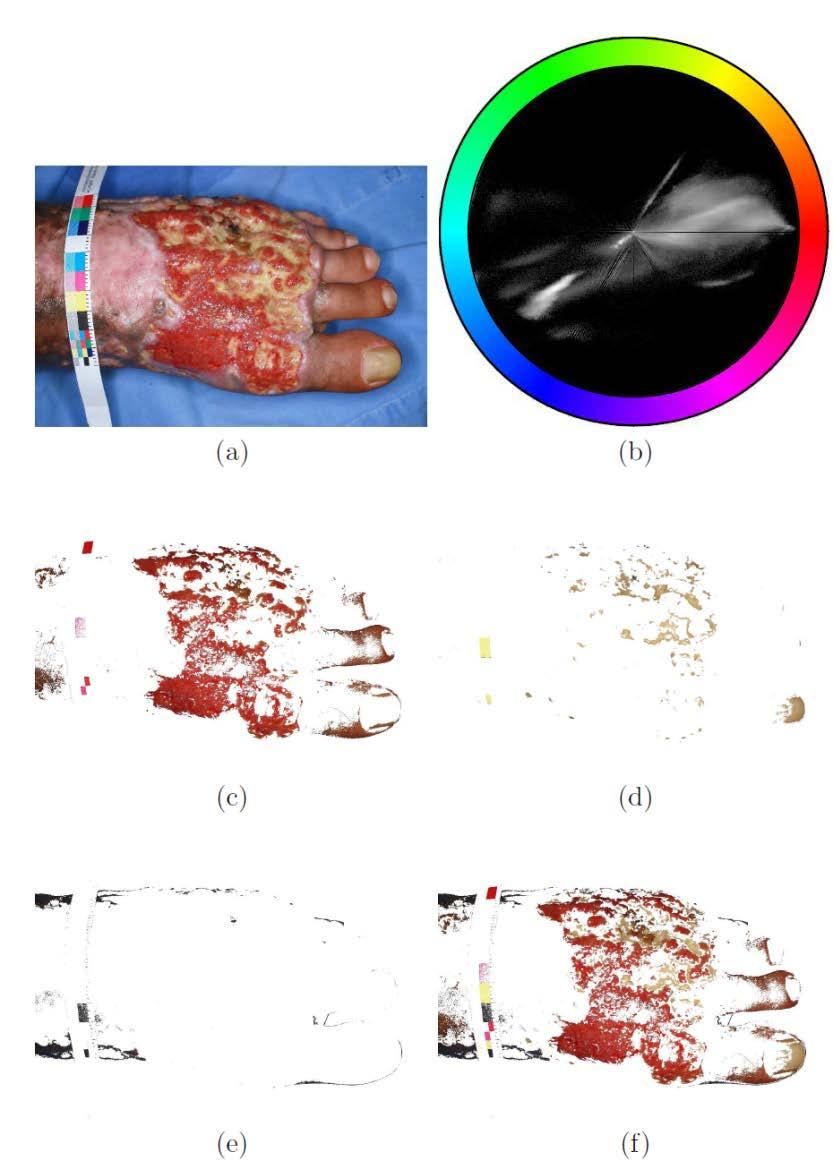 Segmentation of Images of Skin Ulcers Original image Hue-saturation histogram Red (granulation) S>0.
