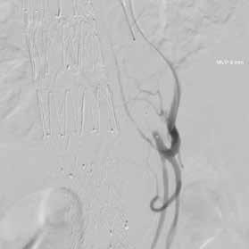 conduct an embolization of the IMA.