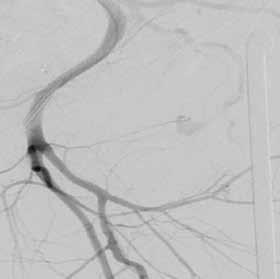 The angiogram shows the circumflex iliac artery and the extravasation and the site