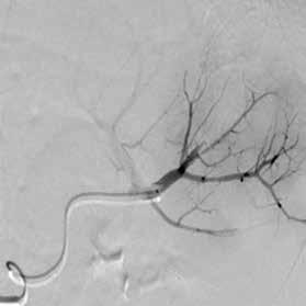 angiogram showed more vascular lesions. Therefore another MVP plug was placed.