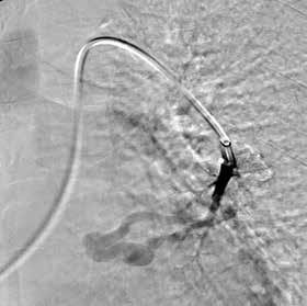 3 mm and 5 mm MVP micro The GDA artery was immediately embolized.