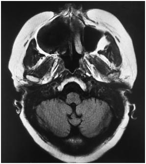 Magnetic susceptibility artifacts Cause The presence of metallic objects or naturally occurring iron in patients that have a hemorrhage causes the spins in the area to be imaged not to be affected by