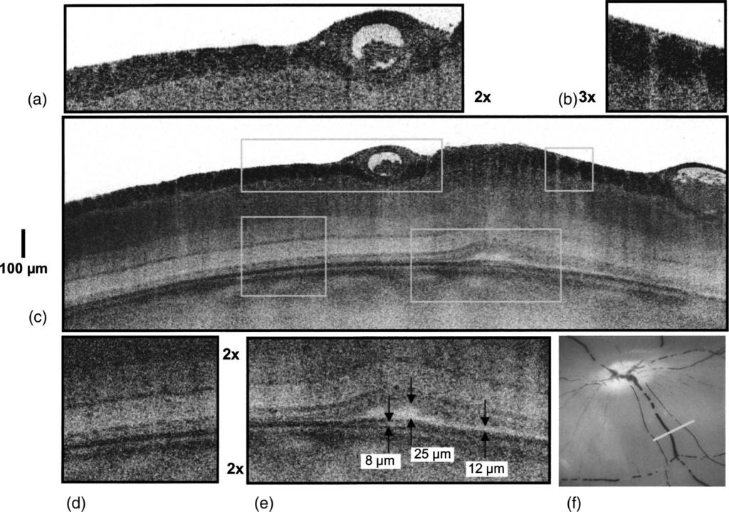Drexler Fig. 11 Ultrahigh-resolution OCT image (1 3 m; axial transverse resolution) of a pig retina 2 h postmortem.