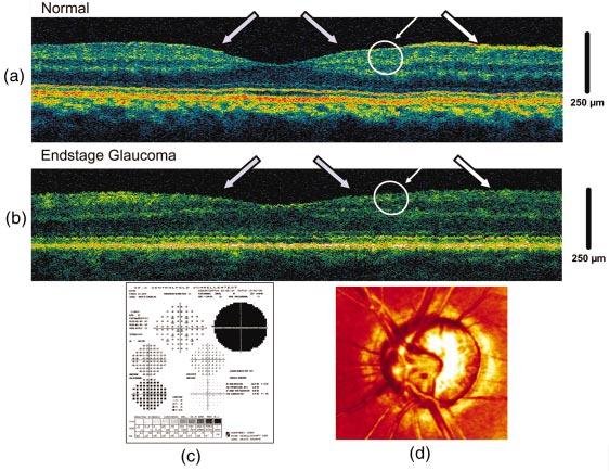 Ultrahigh-resolution optical coherence tomography Fig.
