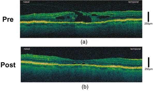Drexler Fig. 18 Monitoring of surgical intervention with in vivo ultrahigh-resolution OCT. A patient with a macular hole is shown before (a) and after (b) surgery. Fig. 28 In vivo spectroscopic OCT of the human retina.
