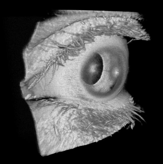 (A) OCT cross sectional image of the anterior eye consisting of 10,000 axial scans over 21mm obtained at 100,000 axial scans per second.