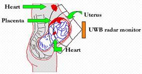 UWB transmitter emits discrete pulses to the human body and the reflected pulses from the heart arrived at UWB receiver and then the result is recorded.