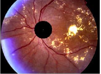 We improve both contrasting attributes of lesions and overall color saturation in image making Optic disc and exudates to appear with same color independent of their location.
