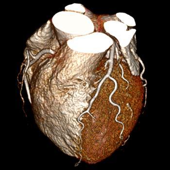 CT in diagnostics 4/4 54-year-old female No obesity Atypical chest pain