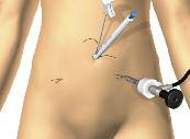 Ligating Abdominal Wall Bleeders Align Suture Guide entry and exit holes perpendicular to vessel.