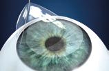 > Laser procedures The flap ist folded to the side The Excimer laser carries out the individual correction Why Femto-LASIK? > The Femto-LASIK method leads to extremely accurate and safe results.