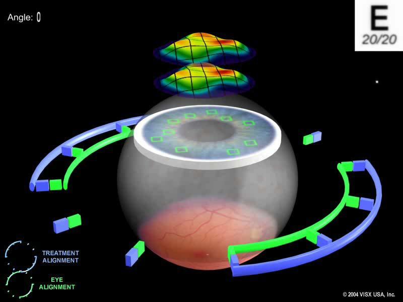 Outcomes of Wavefront guided LASIK for myopia with