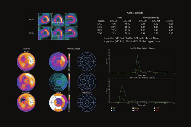 Dynamic SPECT A Breakthrough in Nuclear Cardiac Imaging Gated SPECT acquisitions have been the mainstay of nuclear cardiac imaging for the last two decades, serving as a non-invasive way to image