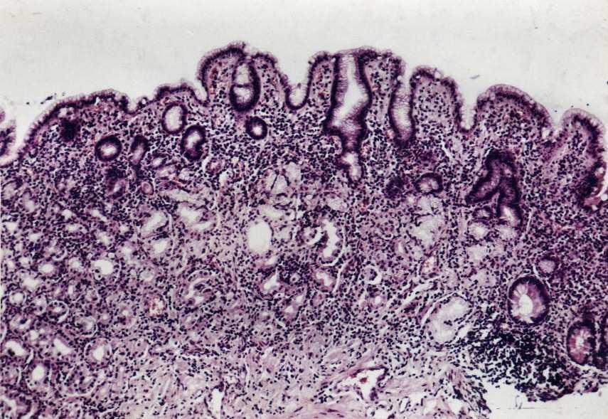 Fig.15Adenocarcinom gastric tip intestinal, diferenńiat, papilar, Ki67+(IHCX2) Leziunile preneoplazice Gastrita cronică atrofică a fost diagnosticată, în prezenńa [35] : disparińiei glandelor în