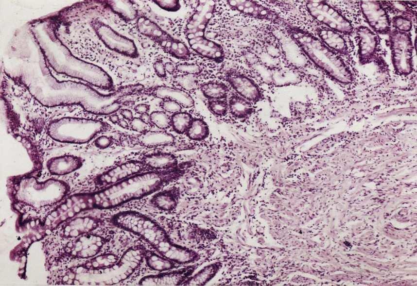 Metaplazia intestinală a fost diagnosticată când [36] : mucoasa are epiteliu înlocuit cu celule caliciforme, celule absorbante, cu sau fără distorsiuni glandulare (Fig.17). Fig.