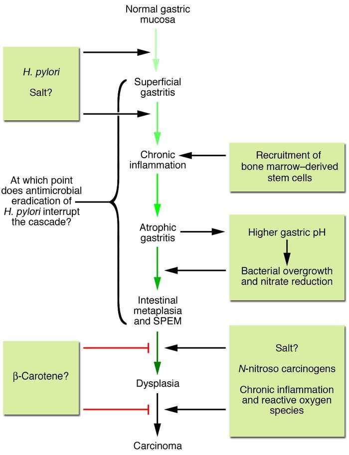 Fig.2 Ipoteza Correa a evoluńiei multistadiale în adenocarcinomul gastric de tip intestinal.