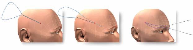 APTOS Thread Is used for the same soft tissues of the face and neck. The Thread with microscopical ledges is connected by the both sides to the needles which are coupled with temporal connection.