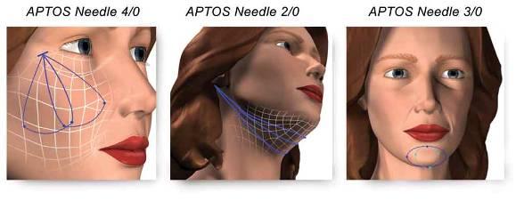 Such lifting is performed with the help of the APTOS Needle, a unique device which makes it possible to suture soft tissues with small stitches just subcutaneously without the suture thread emerging
