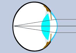 Nearsightedness and farsightedness result from an eye that is not perfectly spherical.