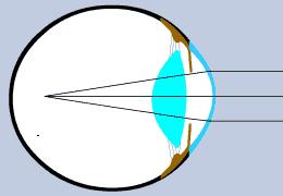 As a result we can see objects in a limited range of the distances that we would like to see. A perfect eye one with no vision defects is one that is very spherical in shape.