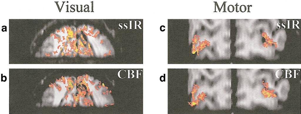 Spin-Echo BOLD and CBF fmri 593 FIG. 4. Representative slab-selective fmri at 4 T obtained using a volume coil. (a) Slice-selective IR (ssir) and (b) CBF activation maps at 1.5 1.5 4.