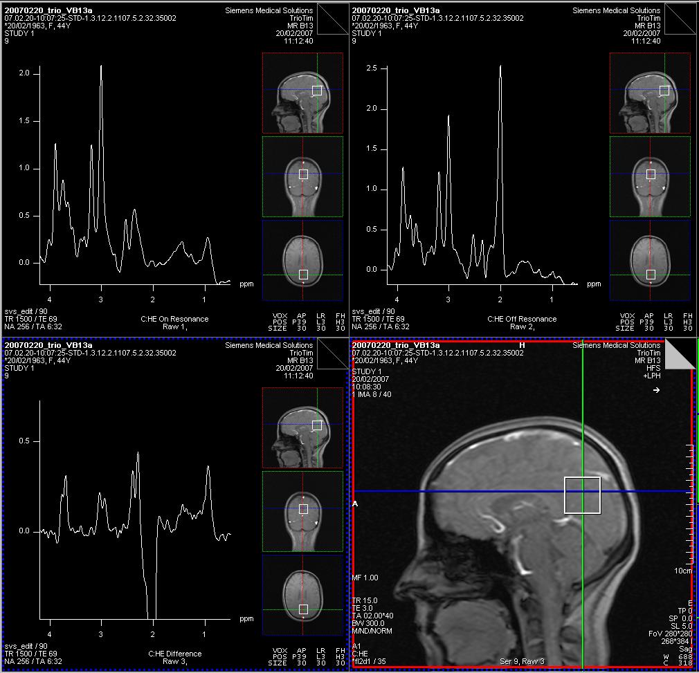 Preliminary Results Examples of GABA detection in the brain of a healthy volunteer, acquired on a MAGNETOM Trio, voxelsize = 27cc, TA = 12 min.s., are shown below: In the edited spectrum (Raw 3) the residual singlet contributions of the choline-signal at 3.