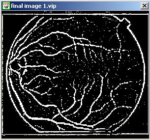 Fig 27. Blood Vessel Segmentation Algorithm 1 s output image A.