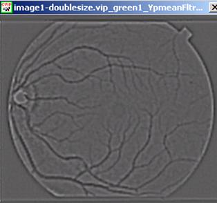 Edges of the Y p -mean filter-filtered image were detected using a Laplacian edge detector to segment blood vessels out of the image.