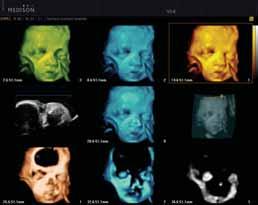Multiple renderings can be viewed in a variety of modes including Surface mode for rapid diagnosis of the fetal mandible, palate, nose and lips, and Maximum mode for at a