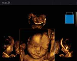 Profile View in Multi Volume Slice TM Fetal Face in Mirror View TM Multi-OVIX TM (Oblique View extended) Multi-OVIX allows users to examine 3D volume data in unlimited planes