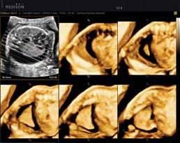 Fetal Face in 3D OH TM Fetal Spine in 3D OH TM Full Zoom TM Full zoom TM reduces eyestrain and increases diagnostic confidence by allowing you to view 3D images at maximum