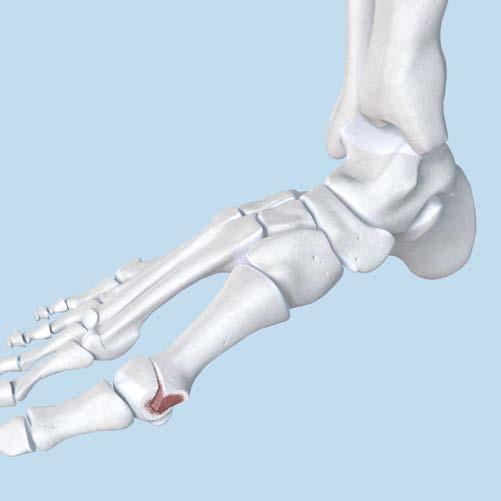 First Metatarsal Osteotomy The following is a simplified description of the first metatarsal osteotomy (Austin