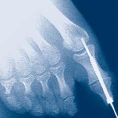 arthrodeses of small joints; bunionectomies and