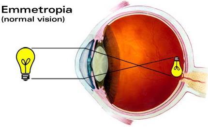 REFRACTIVE ERRORS 16 Refractive errors occur when abnormalities of the eye prevent the proper focus of light on the retina.