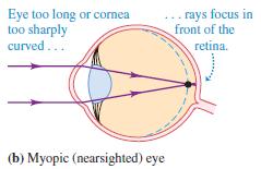 17 REFRACTIVE ERRORS A normal eye forms an image on the retina of an object at infinity when the eye is relaxed.