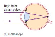 In the myopic (nearsighted) eye, the eyeball is too long from front to back in comparison to the radius of curvature of the cornea (or the
